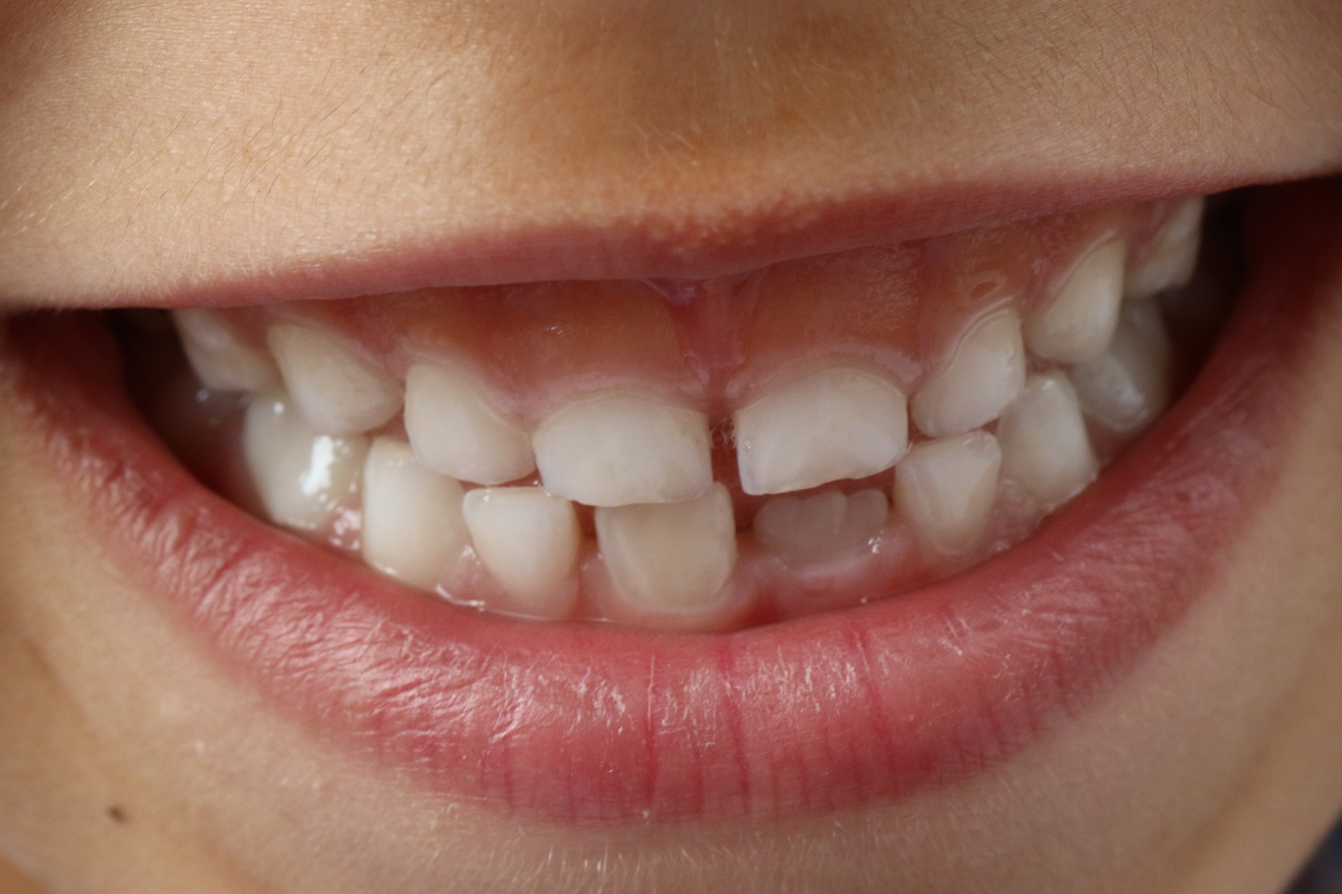 Co zrobić z diastemą? Czy to problem dla stomatologa?