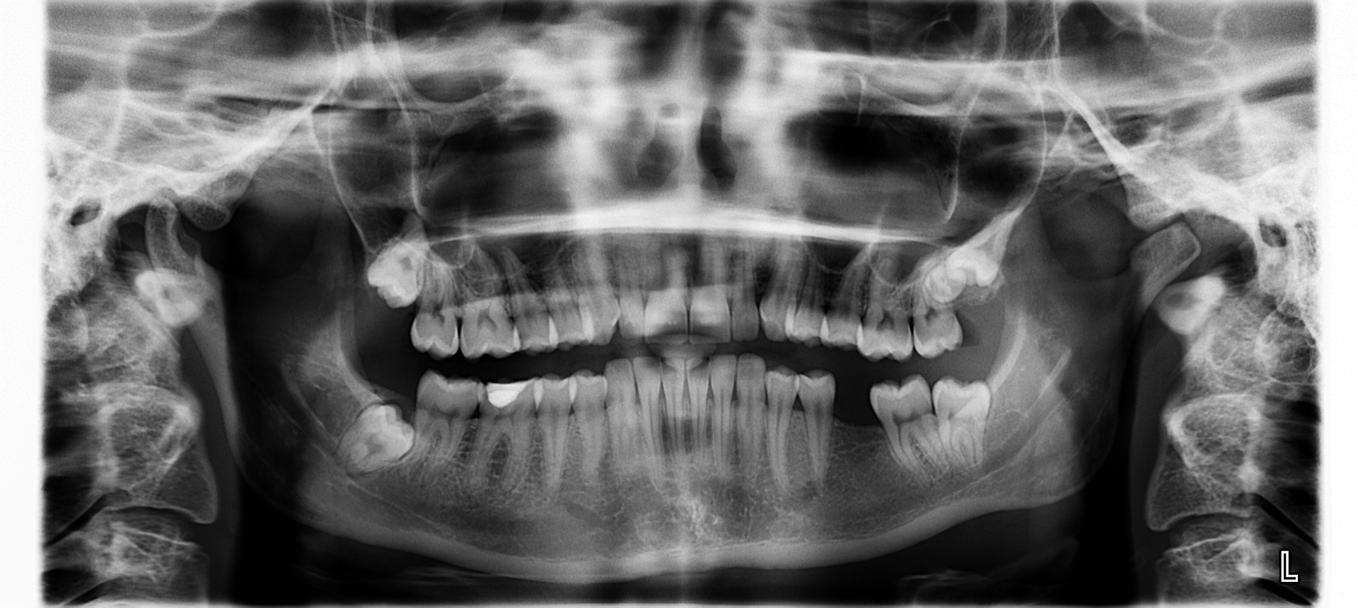 Tomografia komputerowa zębów – na czym polega?